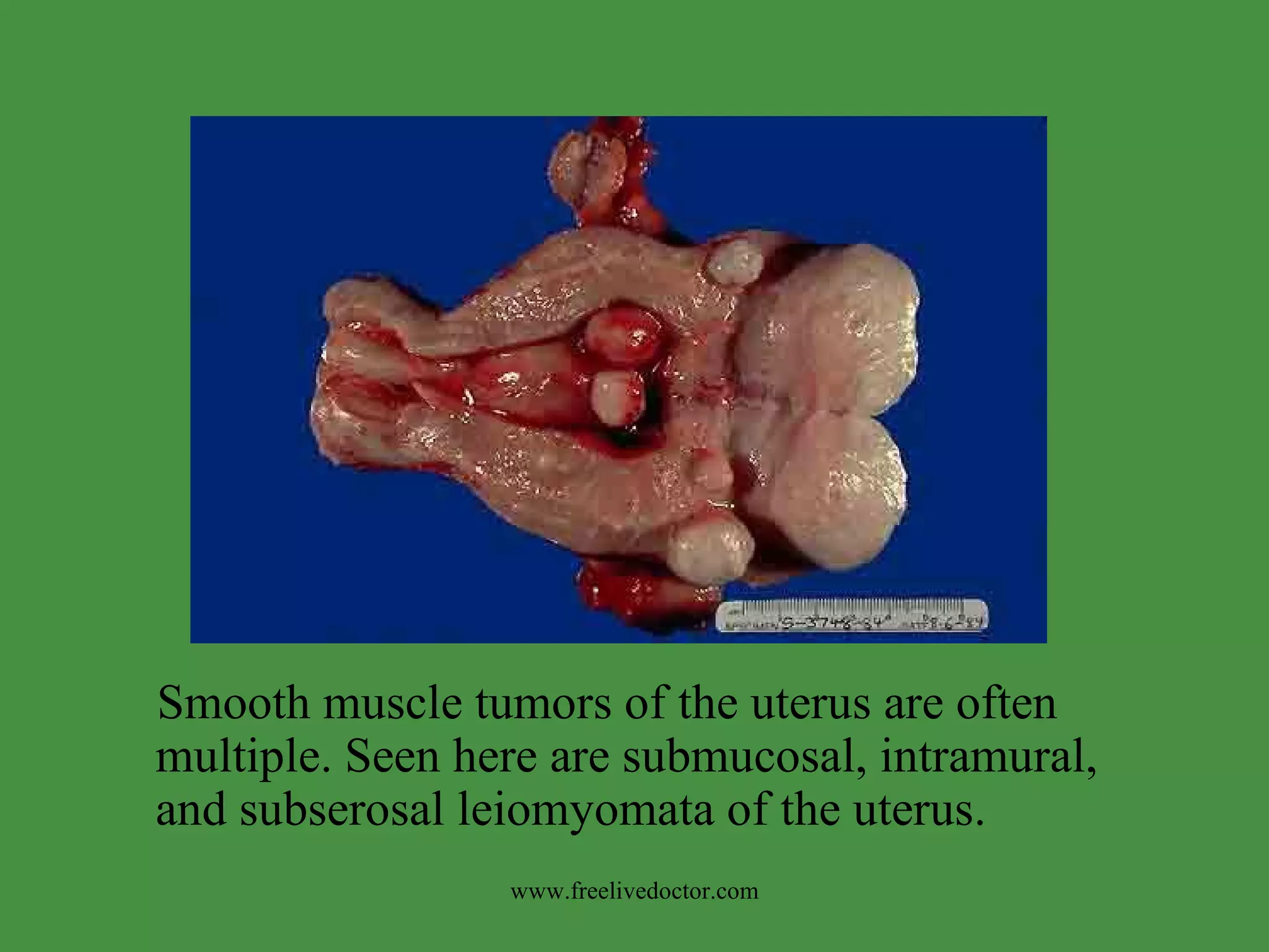 Smooth muscle tumors of the uterus are often multiple. Seen here are submucosal, intramural, and subserosal leiomyomata of the uterus. www.freelivedoctor.com 