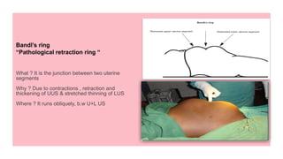 Pathologic Retraction Ring NORMAL AND ABNORMAL UTERINE ACTIONs.pptx