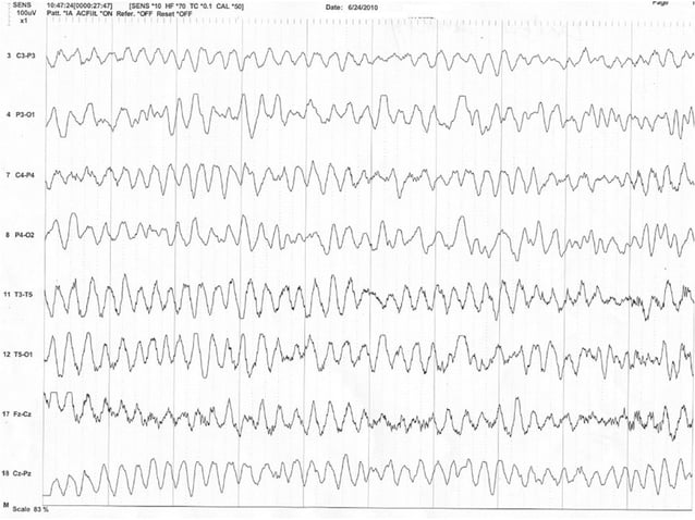 Normal awake and sleep EEG | PPT | Parenting Babies and Toddlers ...