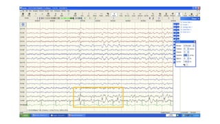 Comprehensive Overview of Normal Awake and Sleep EEG Patterns and Their ...