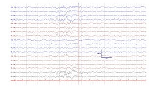 Comprehensive Overview of Normal Awake and Sleep EEG Patterns and Their ...