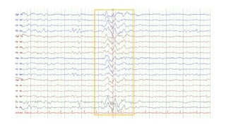 Comprehensive Overview of Normal Awake and Sleep EEG Patterns and Their ...