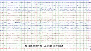 Comprehensive Overview of Normal Awake and Sleep EEG Patterns and Their ...