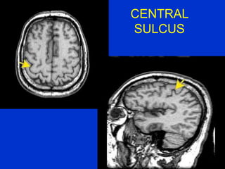 CENTRAL
SULCUS
 