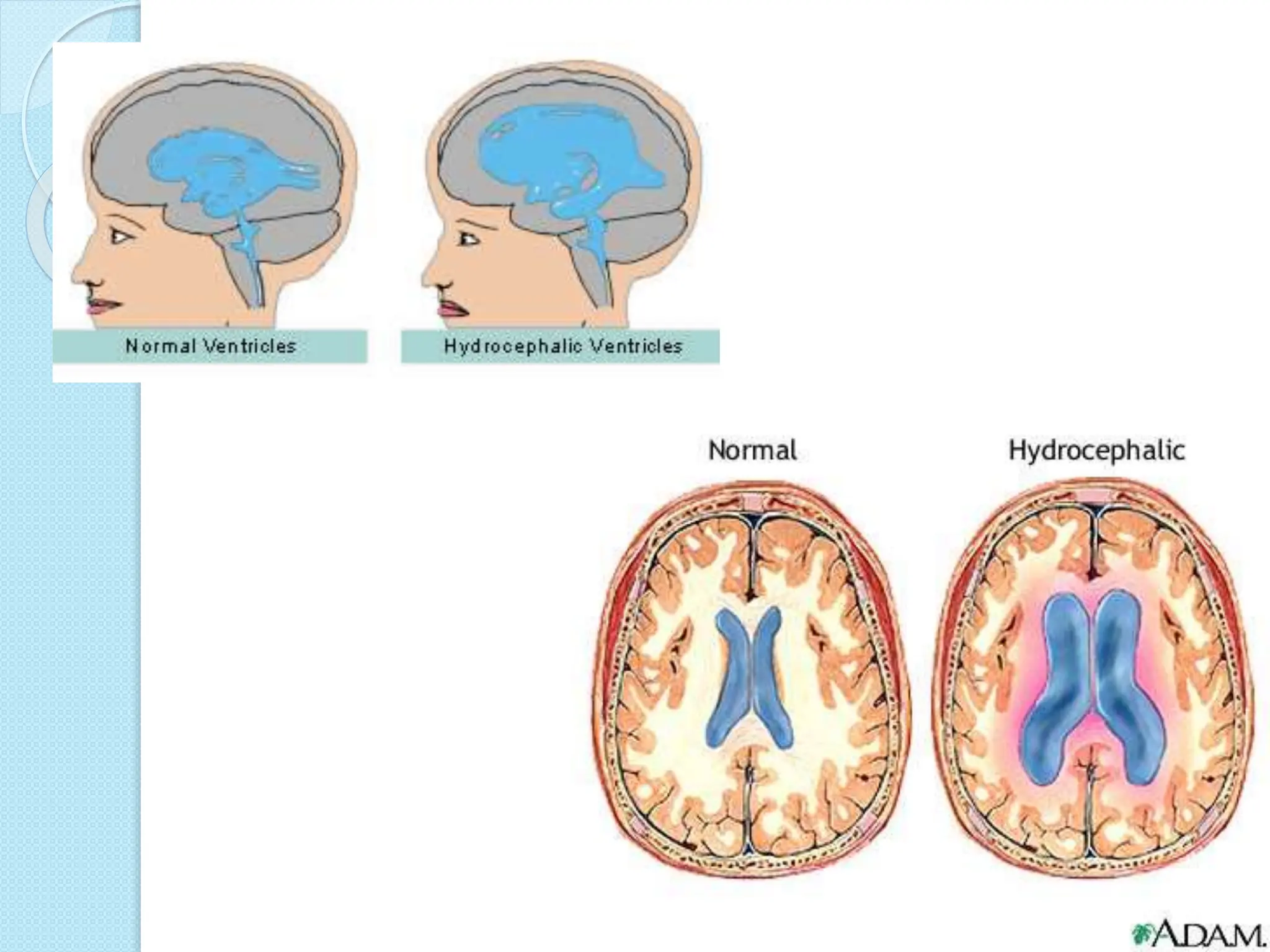 Normal Brain CT Scan Vs Hydrocephalus explained | PPTX