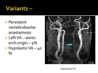  Persistent
vertebrobasilar
anastamosis
 LeftVA – aortic
arch origin – 5%
 HypolasticVA – 40
%
HypoplasticVA
 