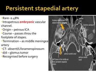 Rare- 0.48%
Intrapetrous embryonic vascular
channel.
Origin – petrous ICA
Course – passes throu the
footplate of stapes.
Termination – as middle meningeal
artery
CT- absentI/Lforamenspinosum
d/d – glomus tumor
Recognised before surgery
 