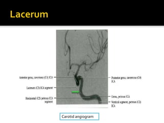Carotid angiogram
 