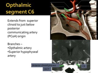 Extends from superior
clinoid to just below
posterior
communicating artery
(PCoA) origin
Branches –
•Opthalmic artery
•Superior hypophyseal
artery
CECT
Anterior clinoid process C6
 