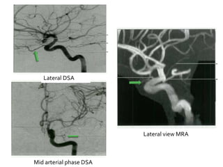 Mid arterial phase DSA
Lateral view MRA
Lateral DSA
 