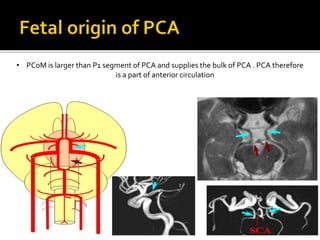 • PCoM is larger than P1 segment of PCA and supplies the bulk of PCA . PCA therefore
is a part of anterior circulation
 
