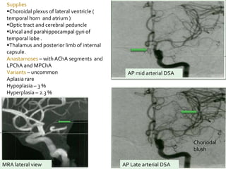 Supplies
Choroidal plexus of lateral ventricle (
temporal horn and atrium )
Optic tract and cerebral peduncle
Uncal and parahippocampal gyri of
temporal lobe .
Thalamus and posterior limb of internal
capsule.
Anastamoses – with AChA segments and
LPChA and MPChA
Variants – uncommon
Aplasia rare
Hypoplasia – 3 %
Hyperplasia – 2.3 %
AP mid arterial DSA
AP Late arterial DSAMRA lateral view
Choriodal
blush
 