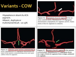 •Hypoplasia or absent A1 ACA
segment.
•Absent , duplicate or
multichannelACoA – 10-15%
 