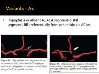 • Hypoplasia or absent A1 ACA segment-distal
segments fill preferentially from other side via ACoA.
 