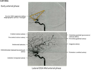 Early arterial phase
Lateral DSA Mid arterial phase
 