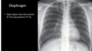 NORMAL CHEST RADIOGRAPGH AND ANATOMY.pptx.pptx