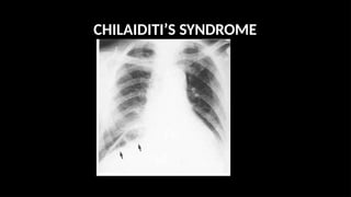 NORMAL CHEST RADIOGRAPGH AND ANATOMY.pptx.pptx