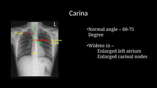 NORMAL CHEST RADIOGRAPGH AND ANATOMY.pptx.pptx