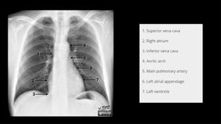 NORMAL CHEST RADIOGRAPGH AND ANATOMY.pptx.pptx