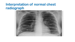 NORMAL CHEST RADIOGRAPH 23-0 7-2019.pptx