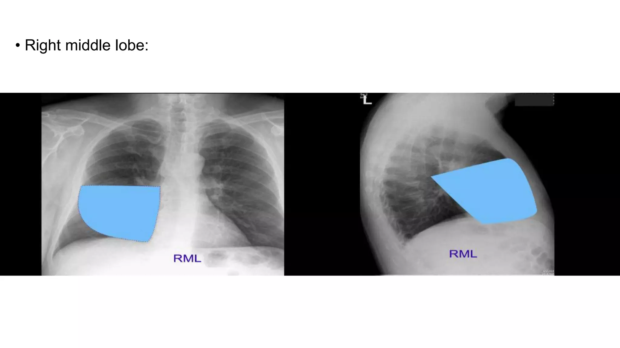 Normal chest x ray- Radiology Basics | PPTX