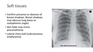 Soft tissues
• Confirm presence or absence of
breast shadows. Breast shadows
may obscure lung bases or
costophrenic angles
• Skin folds may mimic
pneumothorax
• Lateral chest wall (subcutaneous
emphysema)
Left sided mastectomy
 