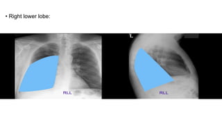 • Right lower lobe:
 