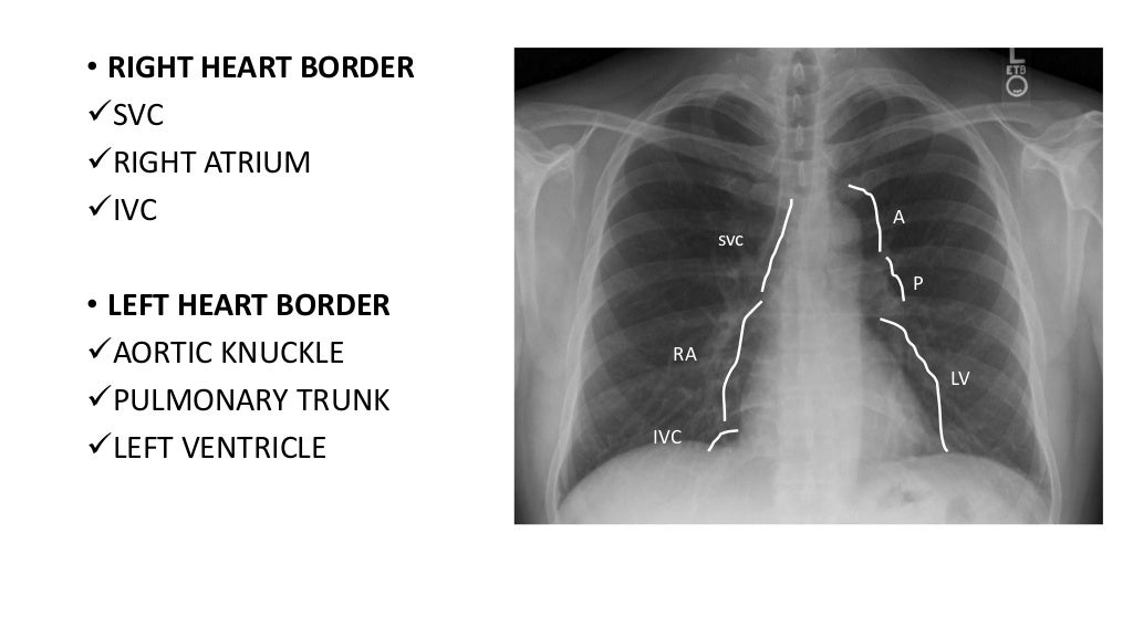 Normal chest x ray Radiology Basics