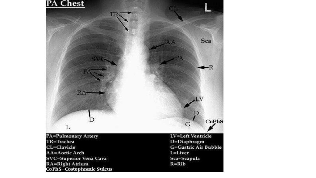 Normal chest x ray Radiology Basics