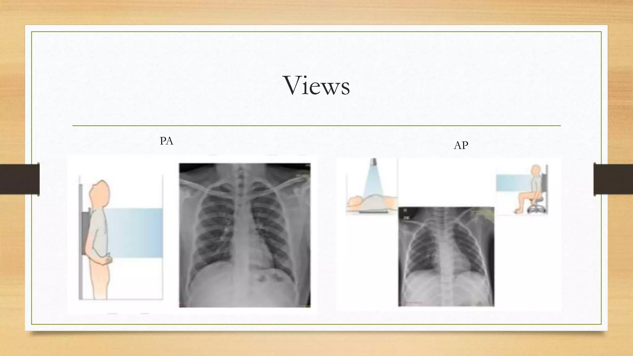 Radiology Chest Xray Normal