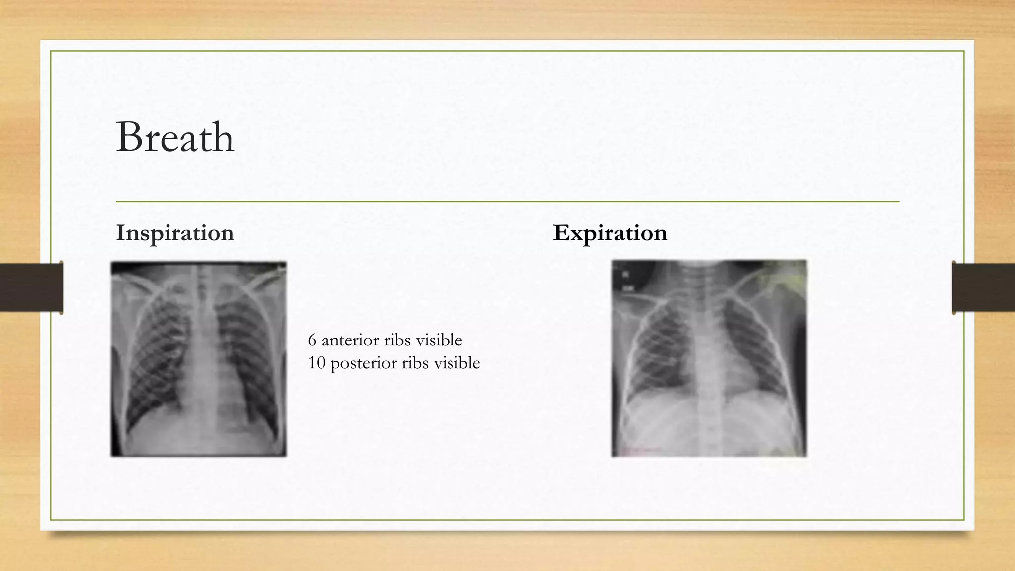 Inspiration Normal Ribs Normal chest x ray | PPTX
