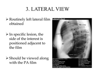 3. LATERAL VIEW
 Routinely left lateral film
obtained
 In specific lesion, the
side of the interest is
positioned adjacent to
the film
 Should be viewed along
with the PA film
 