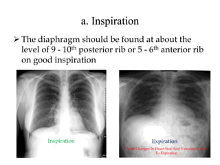 a. Inspiration
 The diaphragm should be found at about the
level of 9 - 10th posterior rib or 5 - 6th anterior rib
on good inspiration
Inspiration Expiration
Note Changes In Heart Size And Vascularity Due
To Expiration.
 