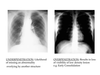 UNDERPENETRATION: Likelihood
of missing an abnormality
overlying by another structure
OVERPENETRATION: Results in loss
of visibility of low density lesion
e.g. Early Consolidation
 