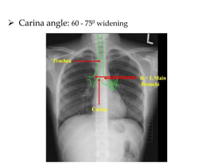  Carina angle: 60 - 750 widening
 