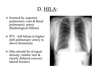 D. HILA:
 Formed by superior
pulmonary vein & Basal
pulmonary artery
(Radiological Hilum)
 97% - left hilum is higher
(left pulmonary artery is
above bronchus)
 Hila should be of equal
density, similar size &
clearly defined concave
lateral borders
 