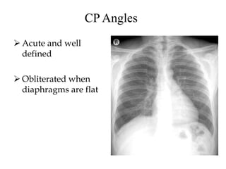 CP Angles
 Acute and well
defined
 Obliterated when
diaphragms are flat
 