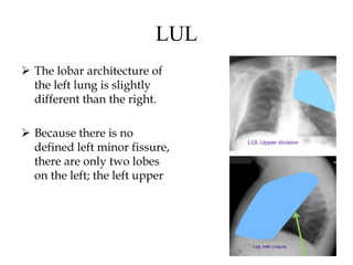 LUL
 The lobar architecture of
the left lung is slightly
different than the right.
 Because there is no
defined left minor fissure,
there are only two lobes
on the left; the left upper
 