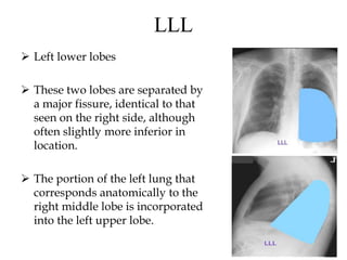 LLL
 Left lower lobes
 These two lobes are separated by
a major fissure, identical to that
seen on the right side, although
often slightly more inferior in
location.
 The portion of the left lung that
corresponds anatomically to the
right middle lobe is incorporated
into the left upper lobe.
 