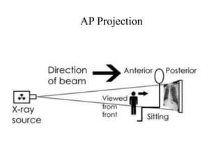 AP Projection
 