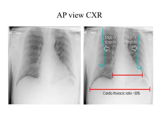 AP view CXR
 