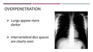  Lungs appear more
darker
 Intervertebral dics spaces
are clearly seen
OVERPENETRATION
 