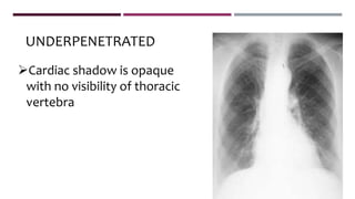 UNDERPENETRATED
Cardiac shadow is opaque
with no visibility of thoracic
vertebra
 