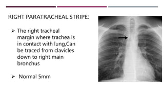  The right tracheal
margin where trachea is
in contact with lung,Can
be traced from clavicles
down to right main
bronchus
 Normal 5mm
RIGHT PARATRACHEAL STRIPE:
 
