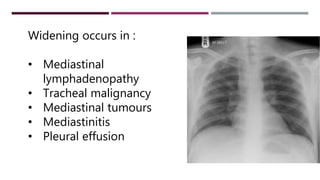 Widening occurs in :
• Mediastinal
lymphadenopathy
• Tracheal malignancy
• Mediastinal tumours
• Mediastinitis
• Pleural effusion
 