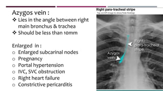 Azygos vein :
 Lies in the angle between right
main bronchus & trachea
 Should be less than 10mm
Enlarged in :
o Enlarged subcarinal nodes
o Pregnancy
o Portal hypertension
o IVC, SVC obstruction
o Right heart failure
o Constrictive pericarditis
 