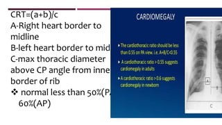 CRT=(a+b)/c
A-Right heart border to
midline
B-left heart border to midline
C-max thoracic diameter
above CP angle from inner
border of rib
 normal less than 50%(PA)
60%(AP)
 