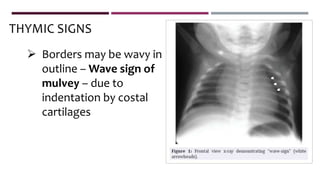  Borders may be wavy in
outline – Wave sign of
mulvey – due to
indentation by costal
cartilages
THYMIC SIGNS
 