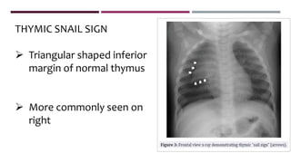 THYMIC SNAIL SIGN
 Triangular shaped inferior
margin of normal thymus
 More commonly seen on
right
 