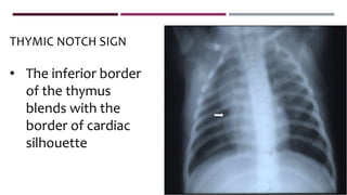 THYMIC NOTCH SIGN
• The inferior border
of the thymus
blends with the
border of cardiac
silhouette
 